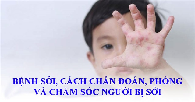 Bệnh Sởi, cách chẩn đoán, phòng và chăm sóc người bị sởi