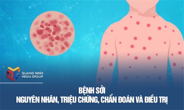 Nguyên nhân, triệu chứng, chẩn đoán và điều trị bệnh sởi